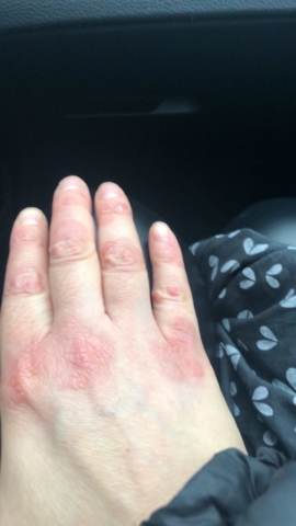 mano con psoriasi - dopo 5 giorni di cura